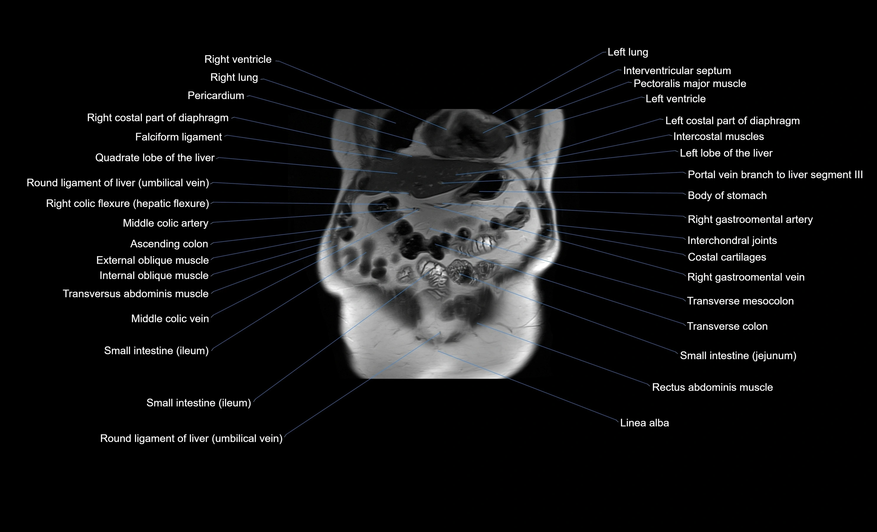 MRI Abdomen coronal labelled cross sectional anatomy radiology  image-img-00001-00013.webp